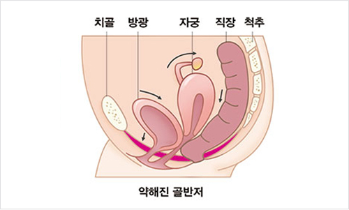 What are Pelvic Floor Disorders?